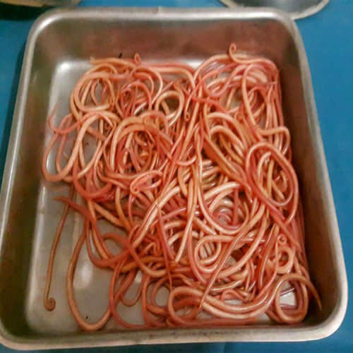 doctors found 150 earthworms in a woman stomach