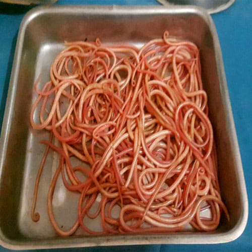 doctors found 150 earthworms in a woman stomach