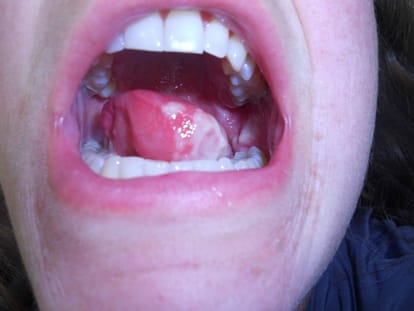 if you have patches on your tongue it may tongue cancer