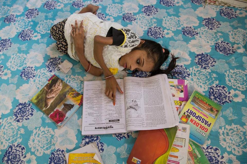 Teenager in India has broken her bones more than 1,000 TIMES due to rare condition