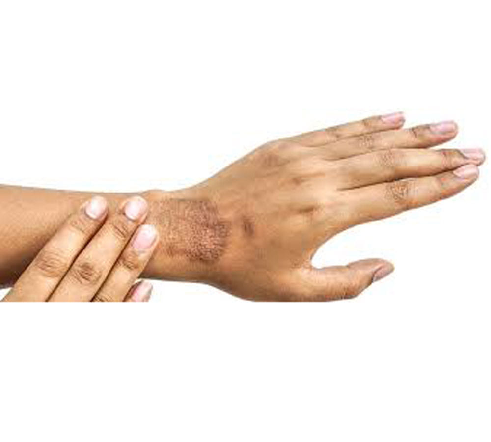 how to get rid of burn scars