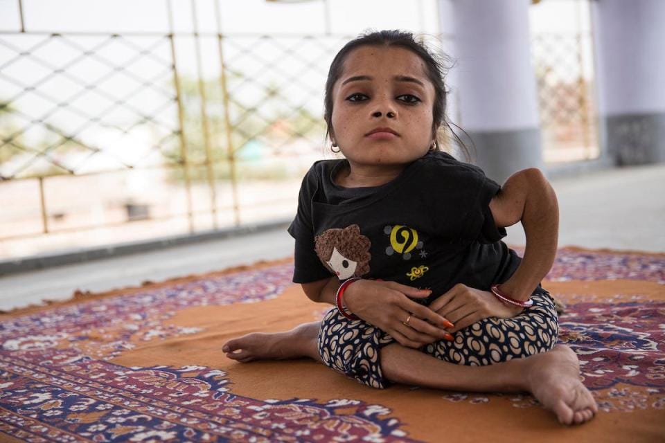 Teenager in India has broken her bones more than 1,000 TIMES due to rare condition