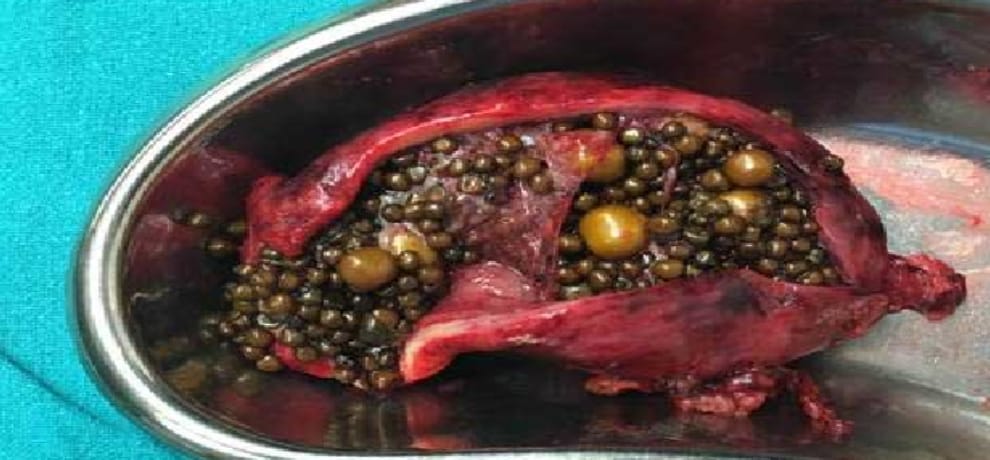 838 stones removed from gall bladder of an old lady