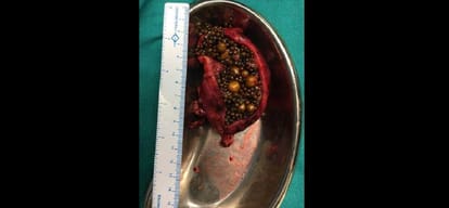 838 stones removed from gall bladder of an old lady