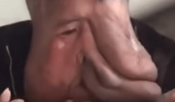 China's Elephant Man 39-year-old with a massive 33lb tumour growing from his face
