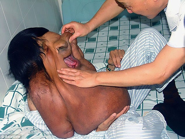 China's Elephant Man 39-year-old with a massive 33lb tumour growing from his face