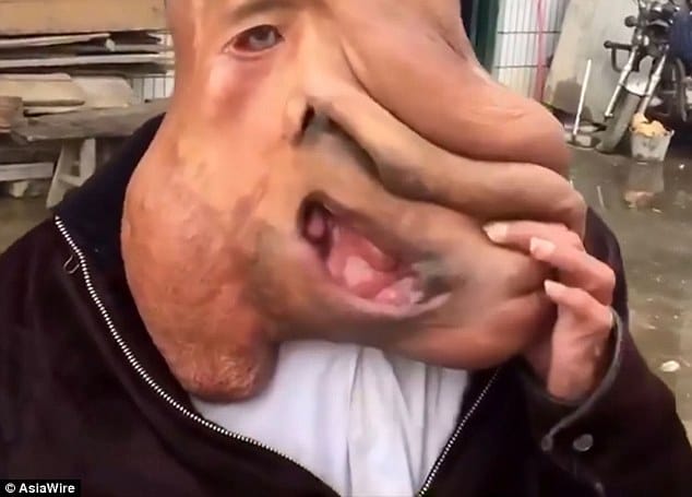 China's Elephant Man 39-year-old with a massive 33lb tumour growing from his face