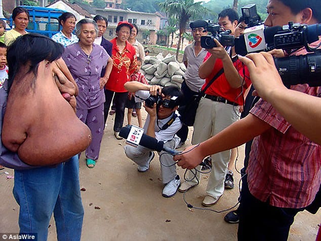 China's Elephant Man 39-year-old with a massive 33lb tumour growing from his face