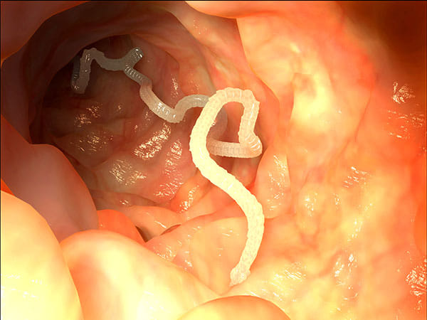 A 5-Foot Tapeworm Being Pulled Out Of A Man’s Nose 