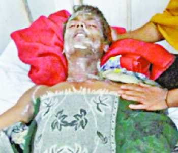 Gas cylinder blast, five scorched