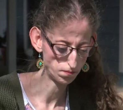 girl suffering from neonatal progeroid syndrome