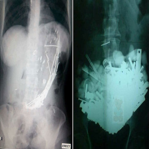 metals found in female stomach after operation