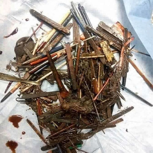 metals found in female stomach after operation