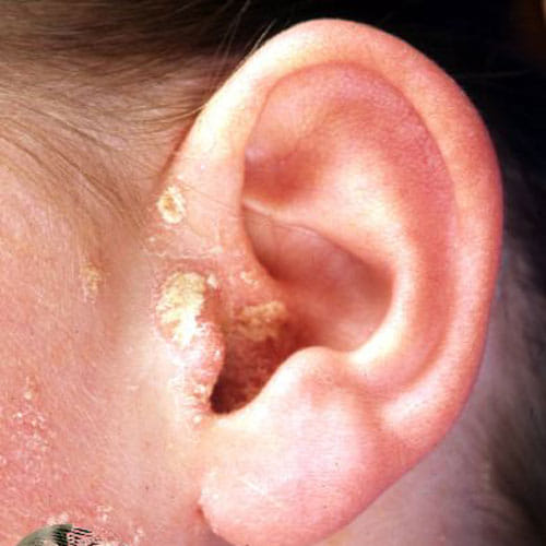 headphone damaged the shape of ears of a man