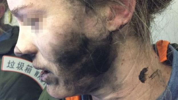 Headphone cracked in the air, burn woman's face