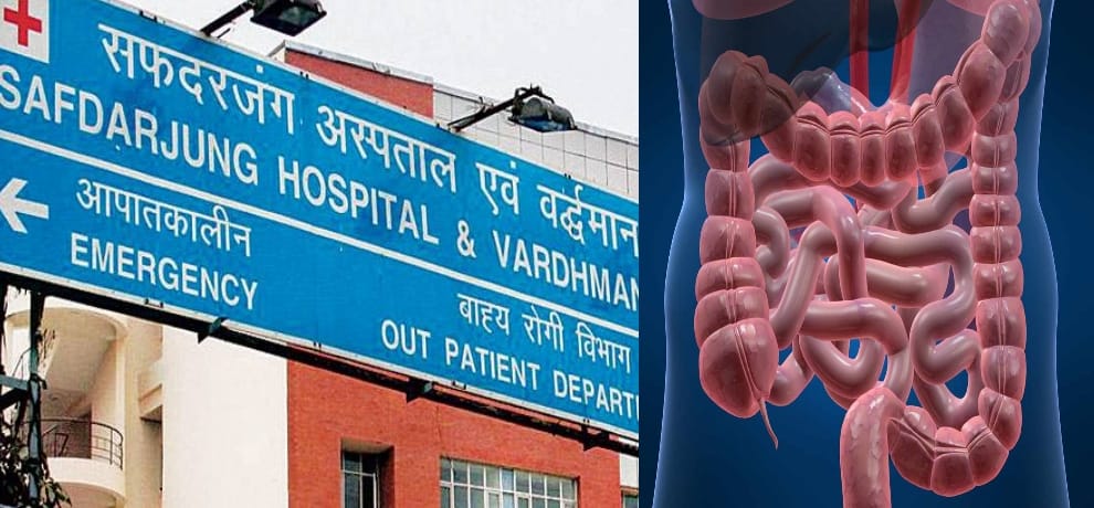 rare intestine transplant successful first time in any government hospital of india