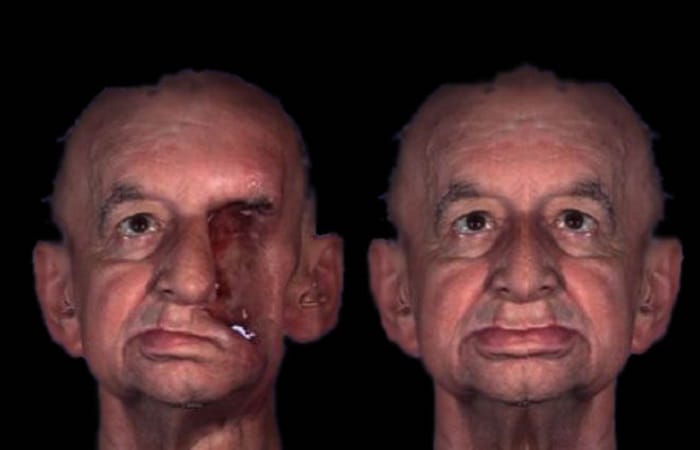 This Man Lost His Face To Nose Cancer