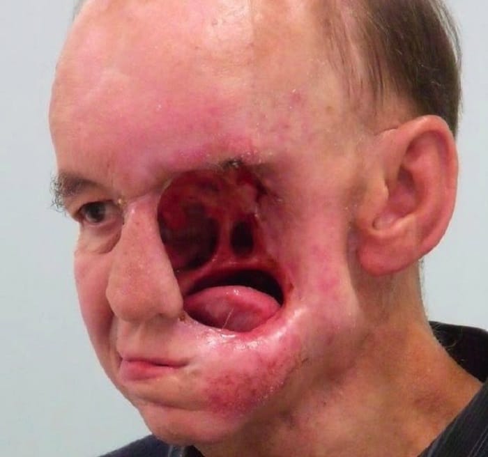 This Man Lost His Face To Nose Cancer
