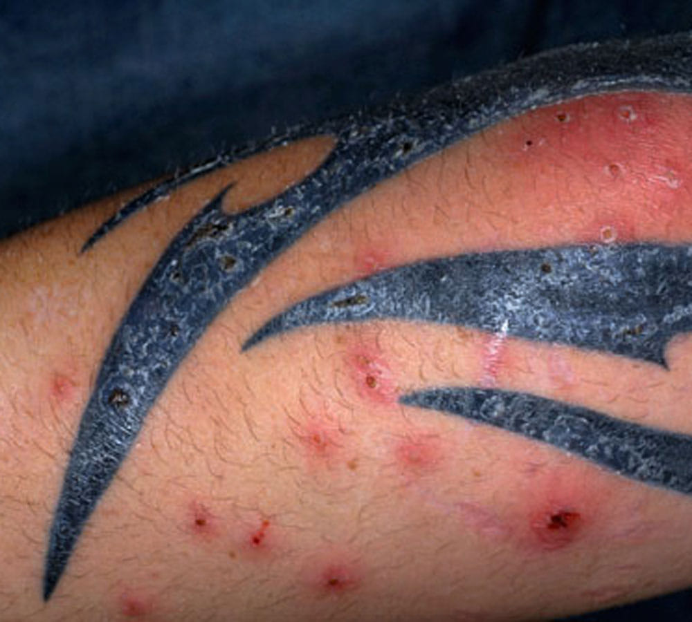 side effects of tattoo