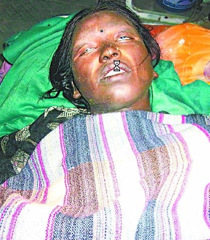 Refusing to go to in-laws Woman burnt, situation severe