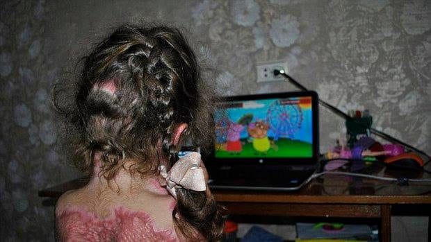  Russian Fire Fairy Game Left 5-Year-Old Girl Seriously Burned.