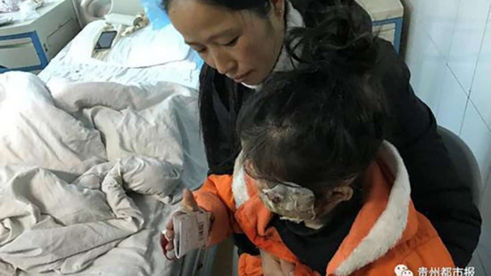  Russian Fire Fairy Game Left 5-Year-Old Girl Seriously Burned.