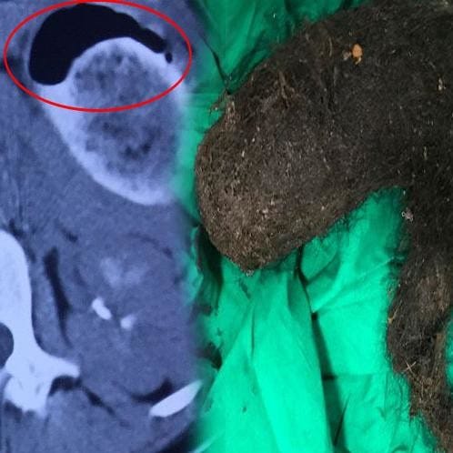 a bunch of hairs release out from a girl stomach. 