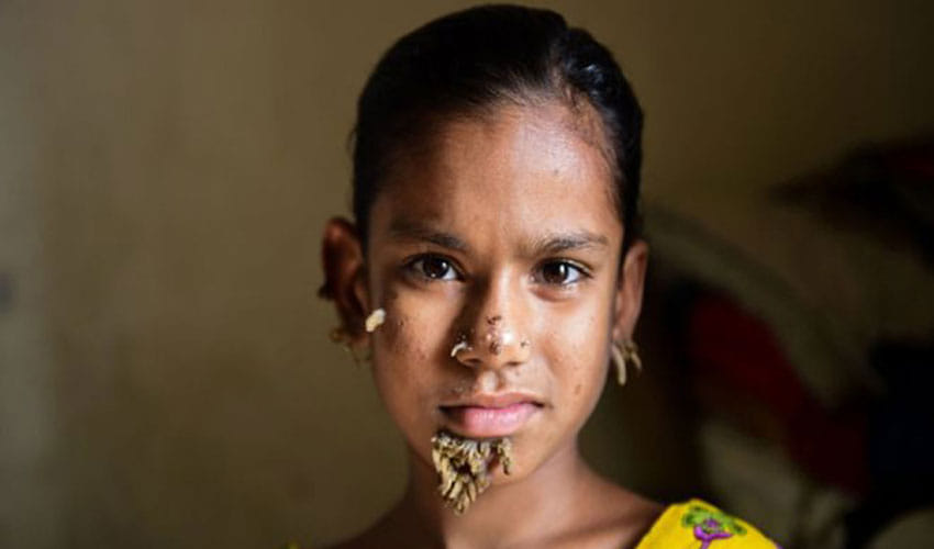 worlds first tree girl in bangladesh