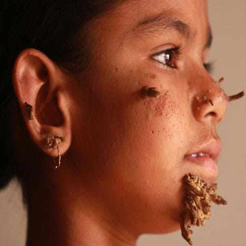 worlds first tree girl in bangladesh