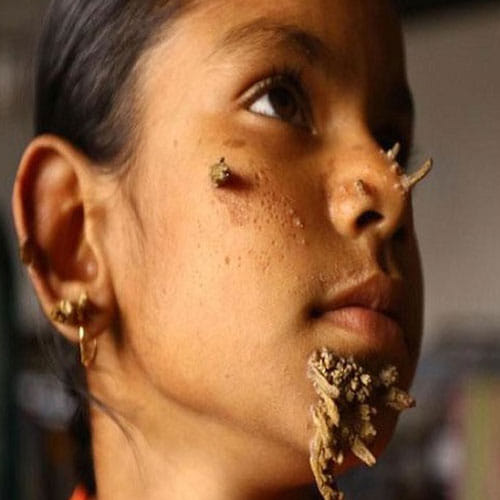 worlds first tree girl in bangladesh