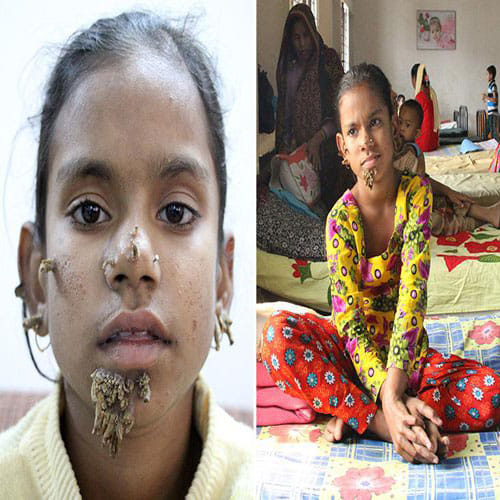 worlds first tree girl in bangladesh