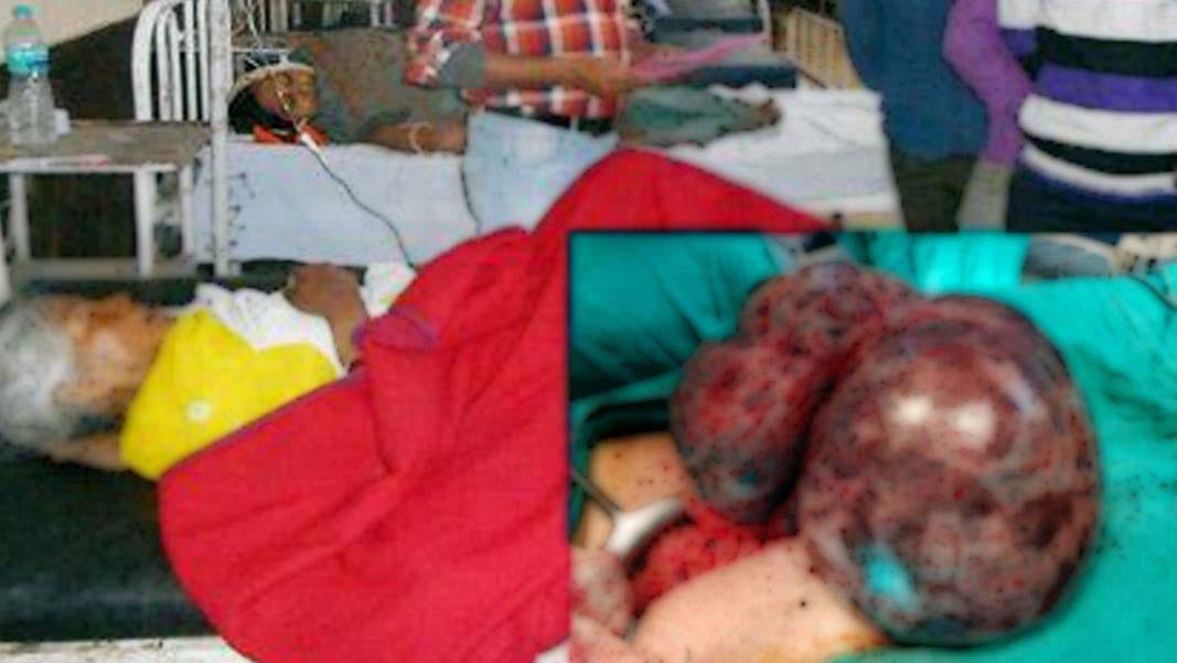 six kg of tumor found from operation