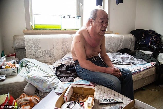 man past 13 years living with an enormous tumor in his neck. 