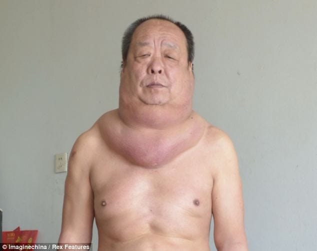 man past 13 years living with an enormous tumor in his neck. 