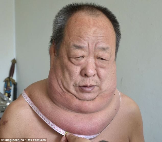 man past 13 years living with an enormous tumor in his neck. 