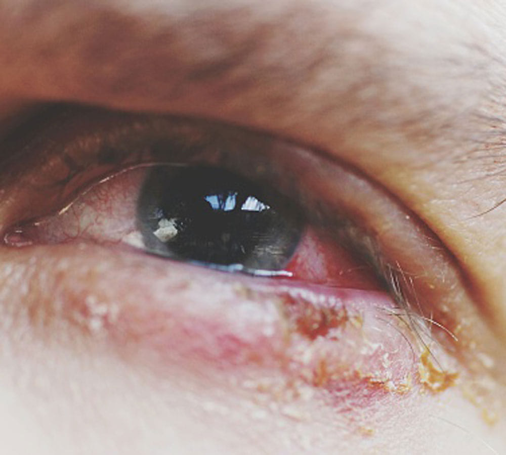 news research shows how contact lenses can make you blind