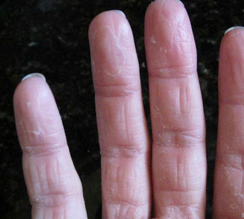 easy ways to get rid of peeling finger tips