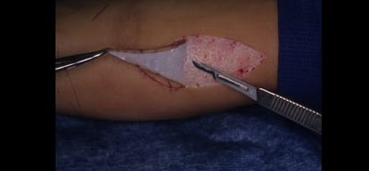 Delhi doctors harvest skin from the cadaver of an 81-year-old man to transplant to burns victims