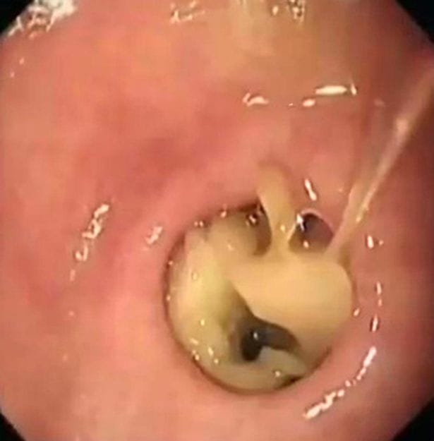 Woman Had Mushrooms Removed By Doctors That Started Growing Inside Her Stomach