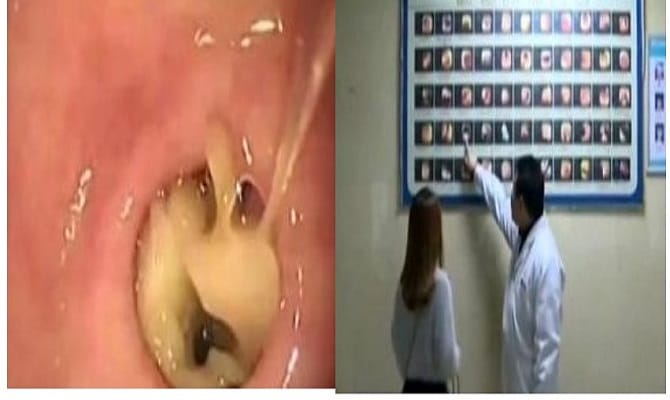 Woman Had Mushrooms Removed By Doctors That Started Growing Inside Her Stomach