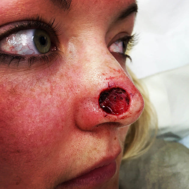 Nurse with coin shaped HOLE in nose because of skin cancer