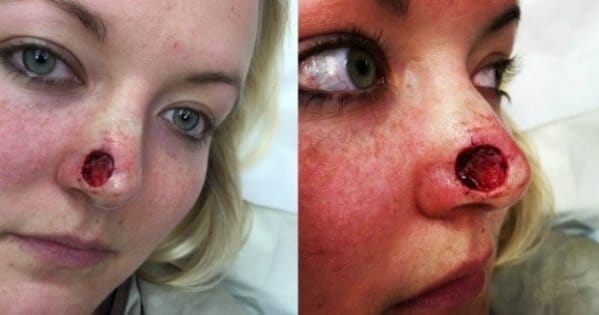 Nurse with coin shaped HOLE in nose because of skin cancer