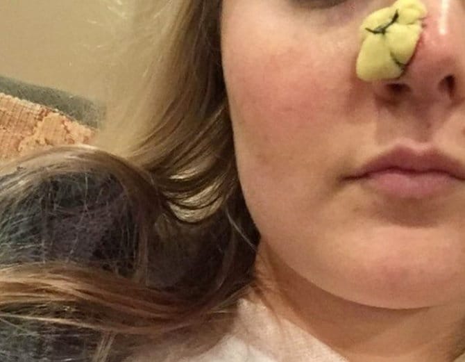 Nurse with coin shaped HOLE in nose because of skin cancer