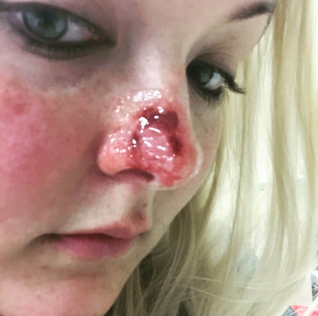 Nurse with coin shaped HOLE in nose because of skin cancer