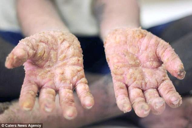 Bangladeshi boy, 8, who was slowly turning into stone