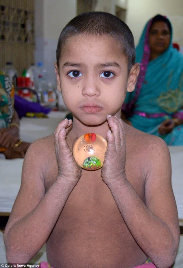 Bangladeshi boy, 8, who was slowly turning into stone
