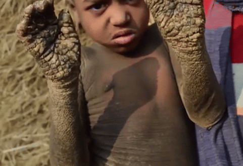 Bangladeshi boy, 8, who was slowly turning into stone