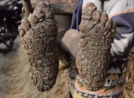 Bangladeshi boy, 8, who was slowly turning into stone