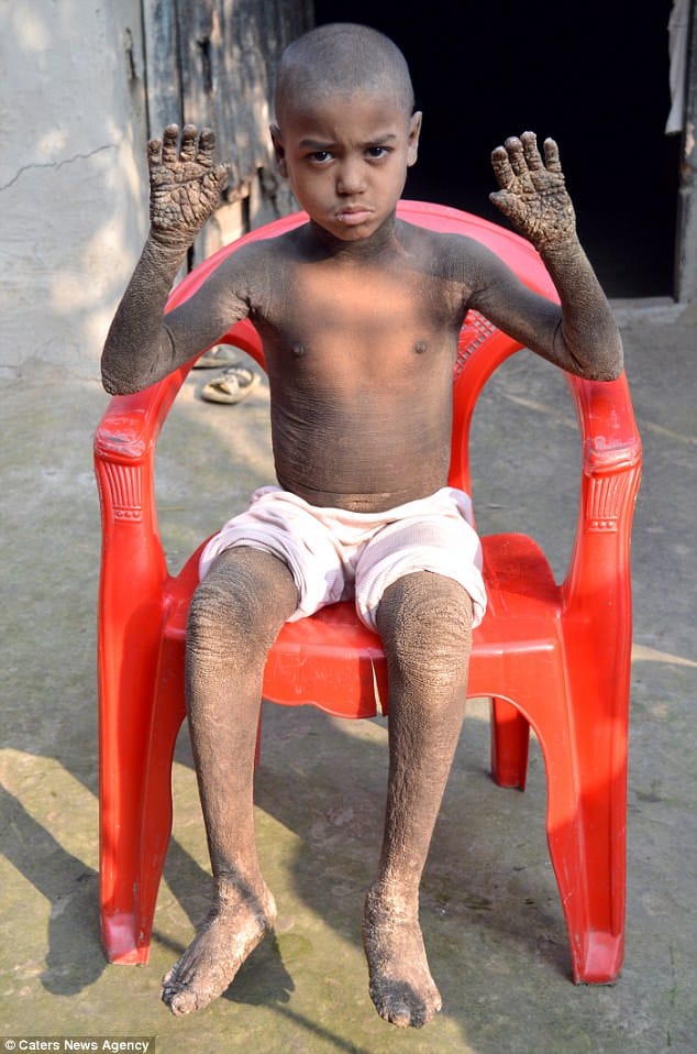 Bangladeshi boy, 8, who was slowly turning into stone