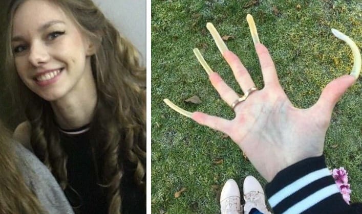 Simone Taylor grows six-inch nails which is now painful.
